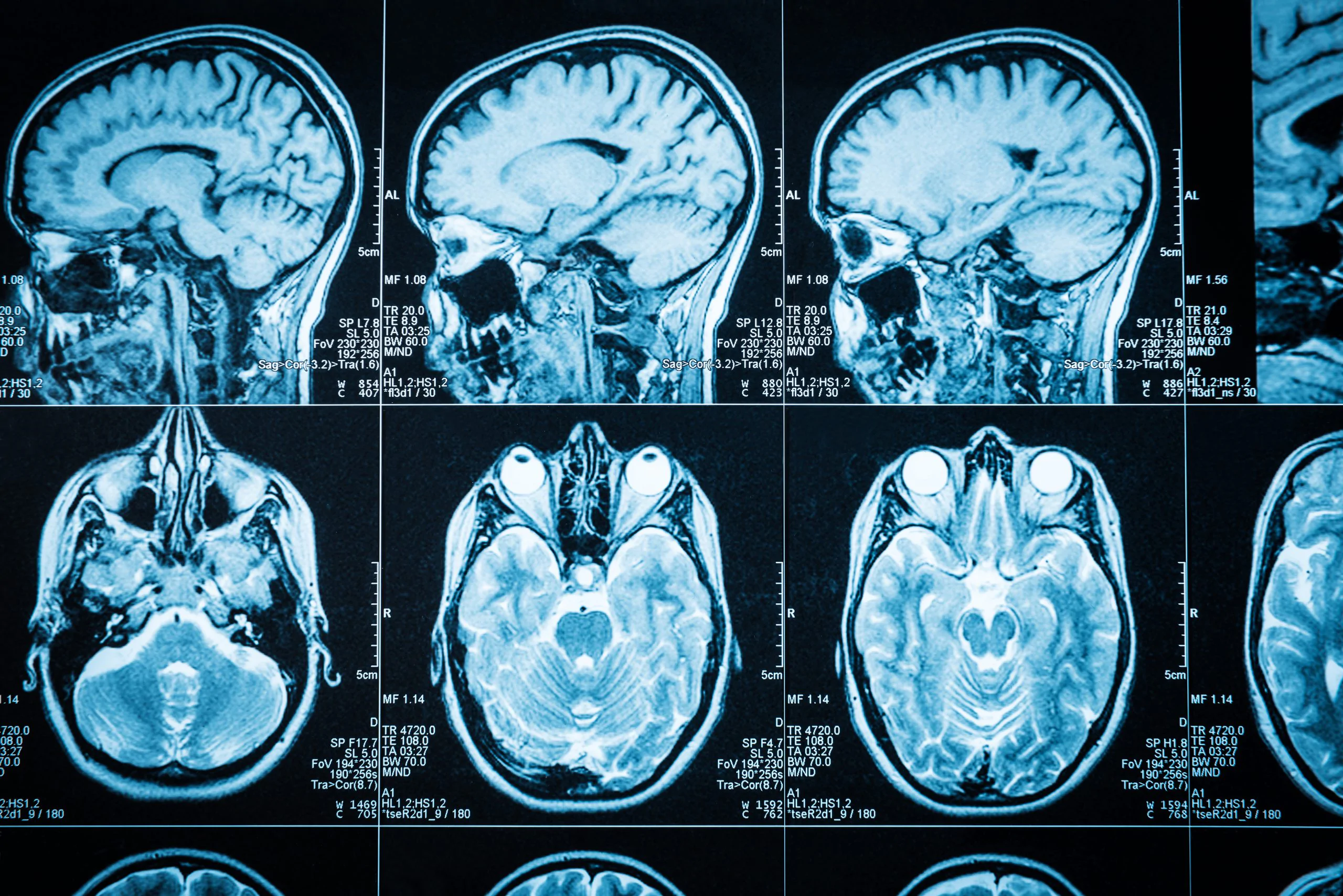 diferentes tipos de lesiones cerebrales traumáticas (tbis)