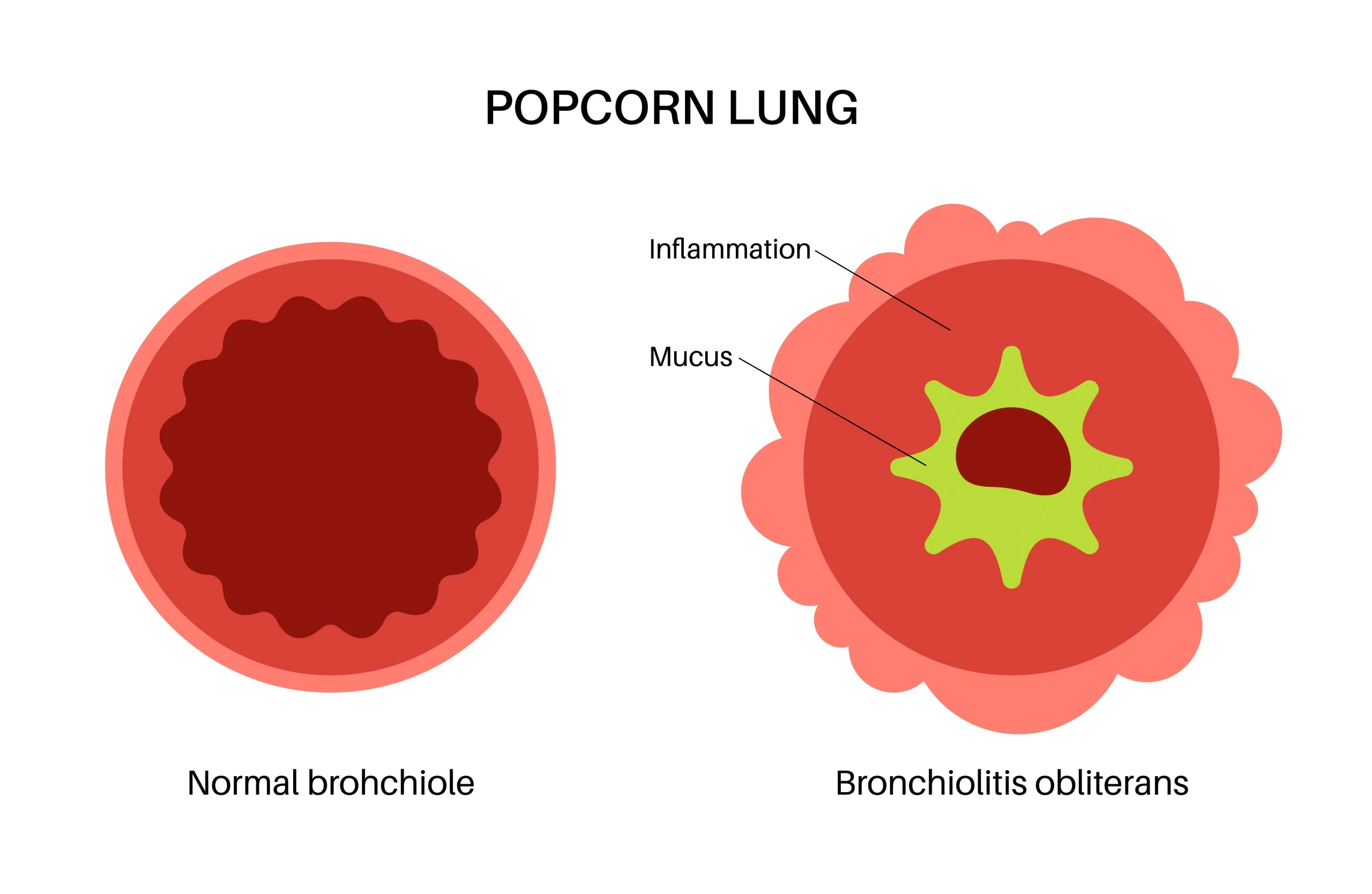 popcorn lung from vaping