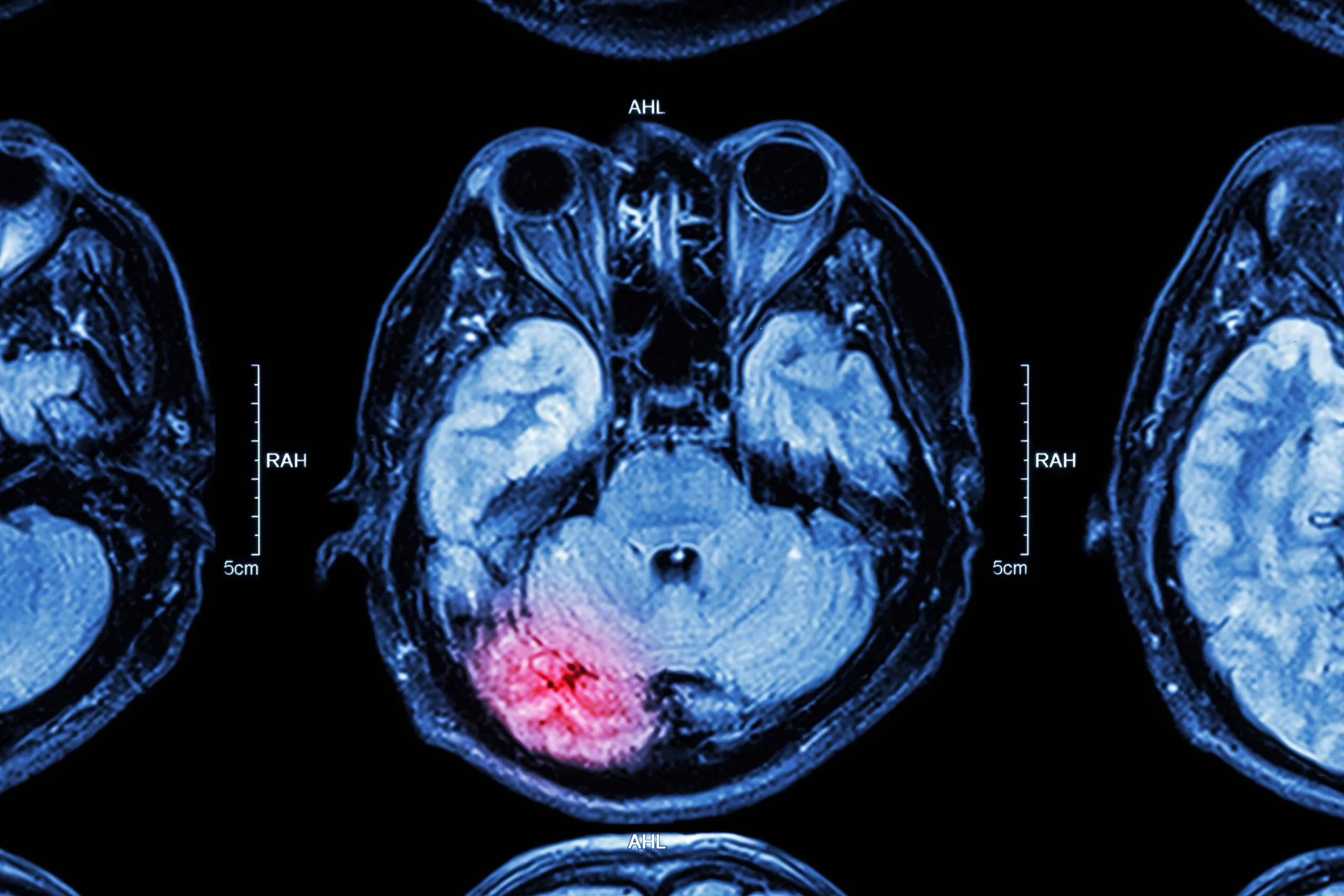 Lesiones cerebrales traumáticas comunes