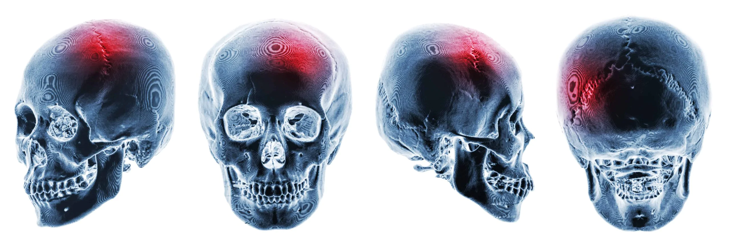 types of skull fracture