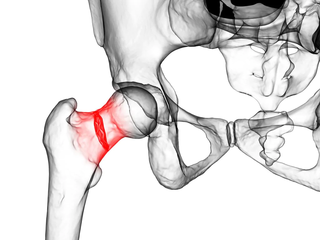 hip fracture of the femur neck